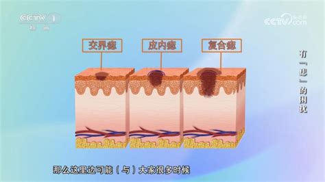 身上的痣|身上的痣能抠吗？凸起的痣和平平的痣哪个更易恶。